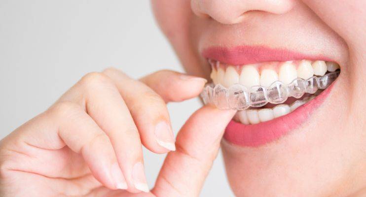 How Invisalign Can Boost Self Esteem and Mental Health Compared to Traditional Braces 1